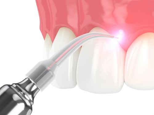 Laser Dentistry