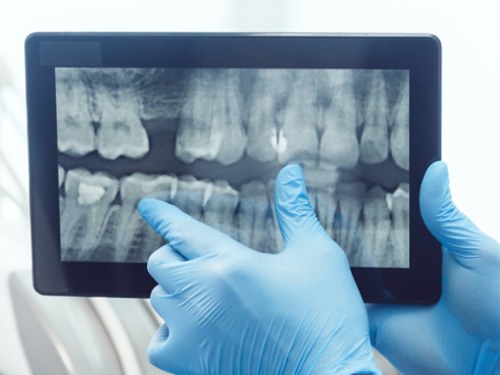 Digital X-Rays